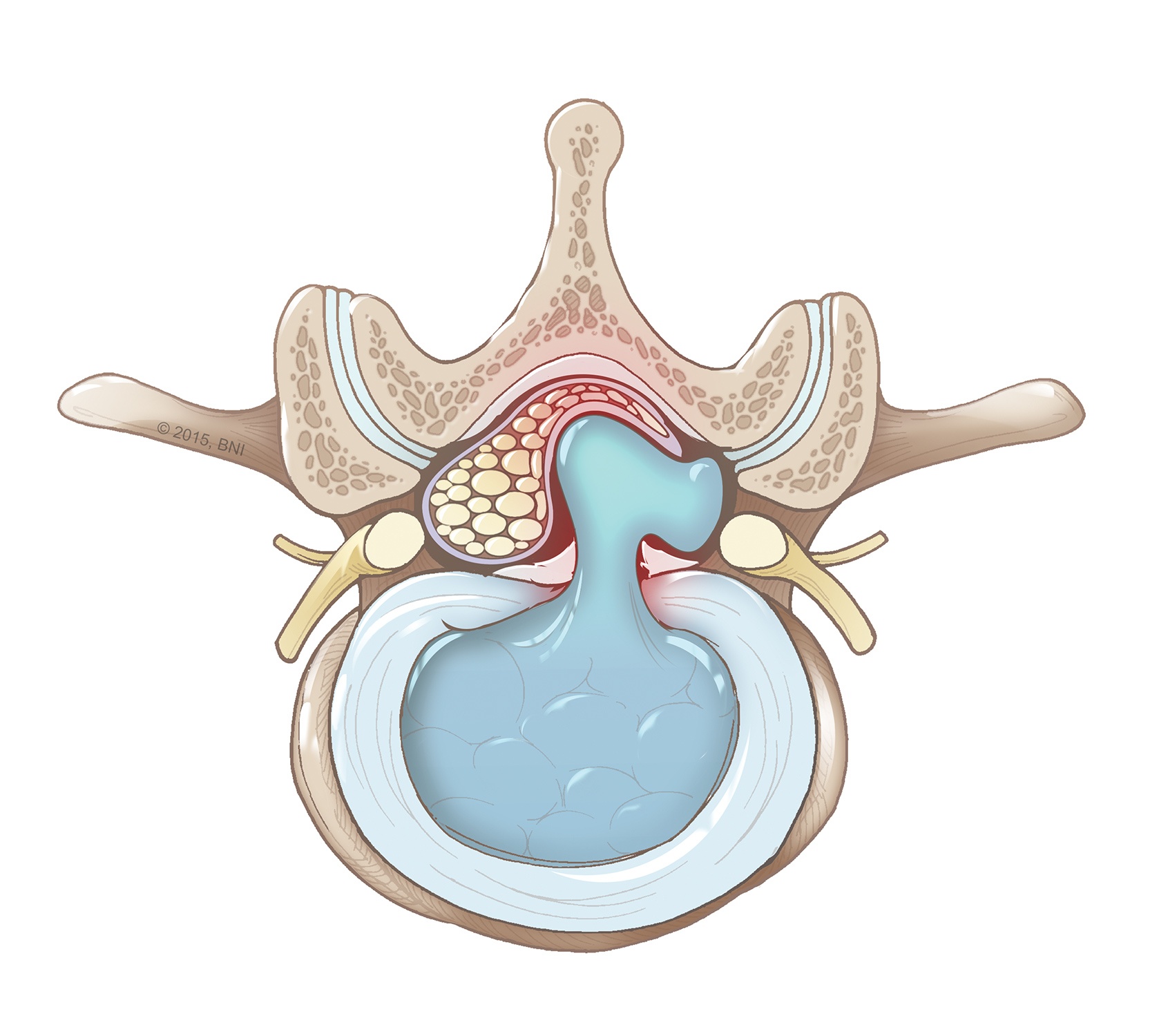 Disc Herniation