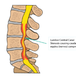 Lumbar-Stenosis-1