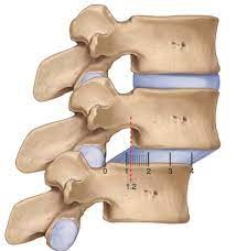 Spondylolisthesis